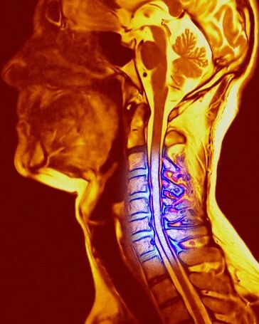Condrose cervical
