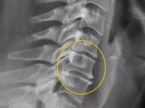 Osteocondrose da columna cervical nunha x raios