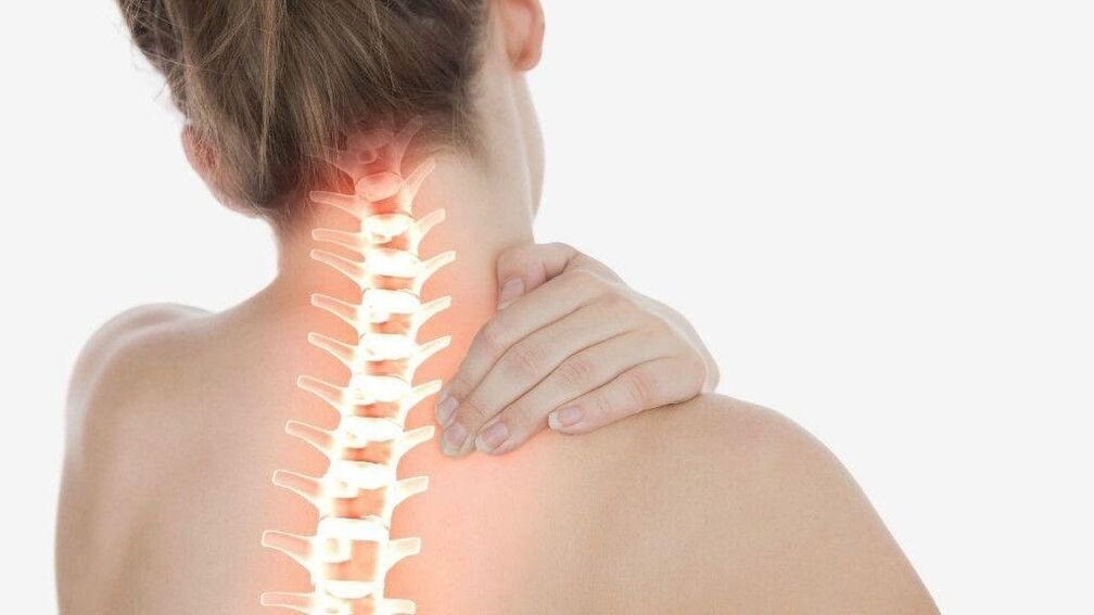 Coa osteocondrose da columna cervical, pódese desenvolver a síndrome radicular