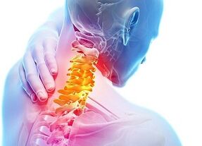 Causas da osteocondrose cervical