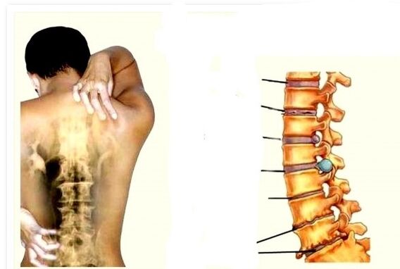 A osteocondrose é a causa da dor nas costas
